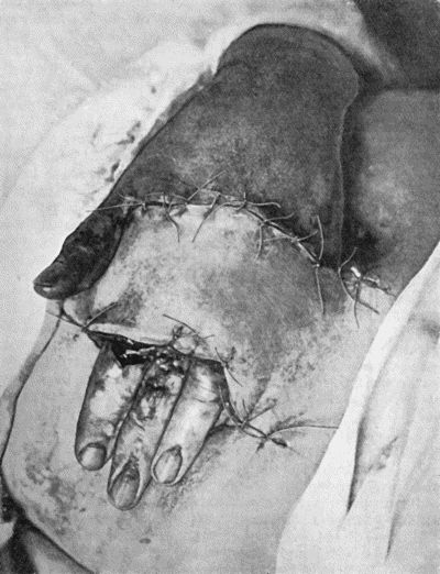 Fig. 1.—Ulcer of back of Hand covered by flap of skin raised from anterior abdominal wall. The lateral edges of the flap are divided after the graft has adhered. Fig. 1.—Ulcer of back of Hand covered by flap of skin raised from anterior abdominal wall. The lateral edges of the flap are divided after the graft has adhered.